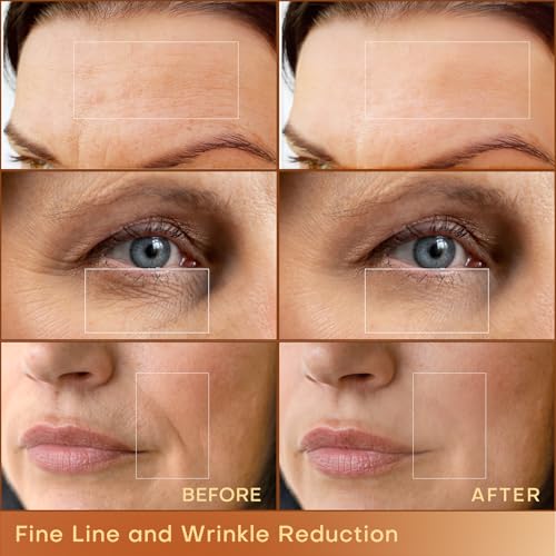 MLAY Professional RF Beauty Machine with 2 Probes for Skin Tightening G829145