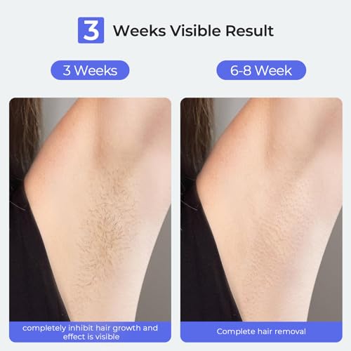 Painless Sapphire Ice IPL Laser Hair Removal Device for Women and Men J58740